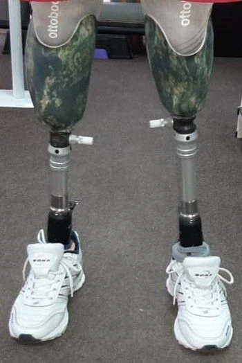 Modular Lower Leg Prosthesis for Partial Development Cases