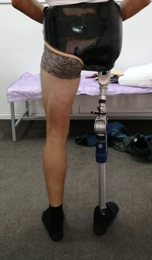 Modular Hip Disarticulation Prosthesis