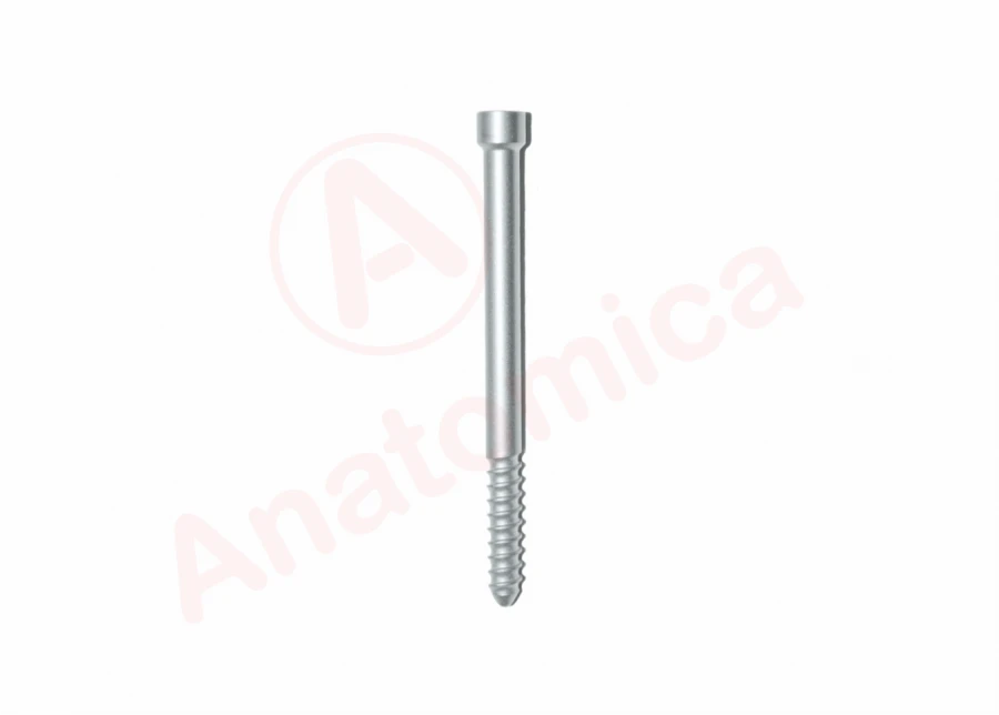 Proximal Locking Screw for Fracture Stabilization