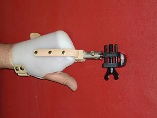 Functional Hand Prosthesis for Partial Hand Amputation