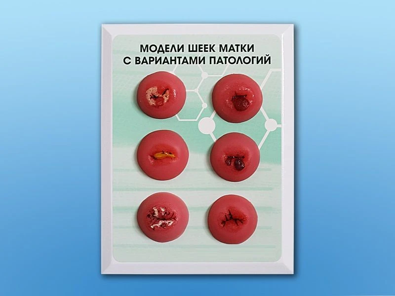 Educational Demonstration Model of Cervical Pathologies GP6611