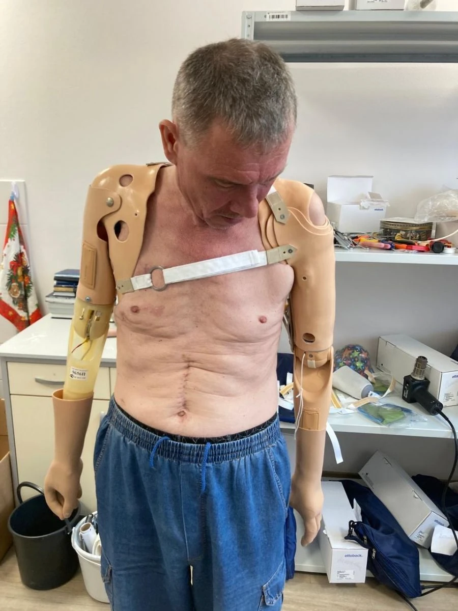 Functional-Cosmetic Prosthesis for Above-Elbow Amputation