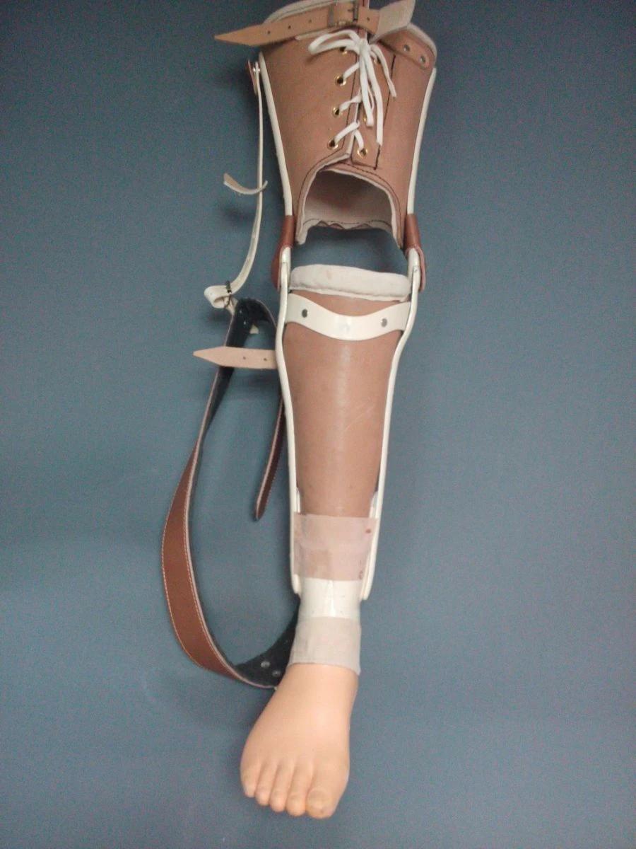 Non-modular Lower Leg Prosthesis for Congenital Underdevelopment