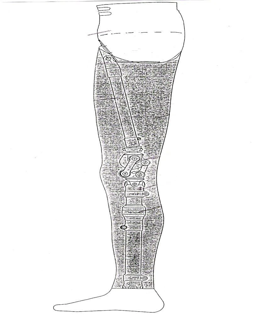 Modular Hip Disarticulation Prosthesis