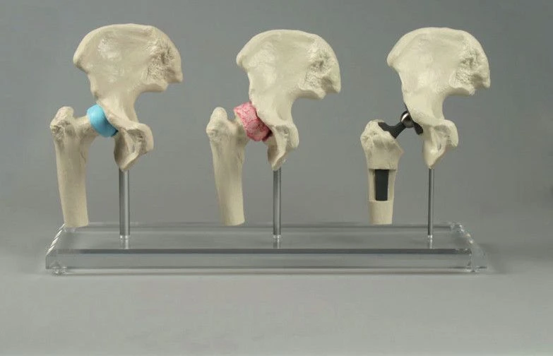 Hip Joint Model Set with Pathological and Implant Variants, 11205