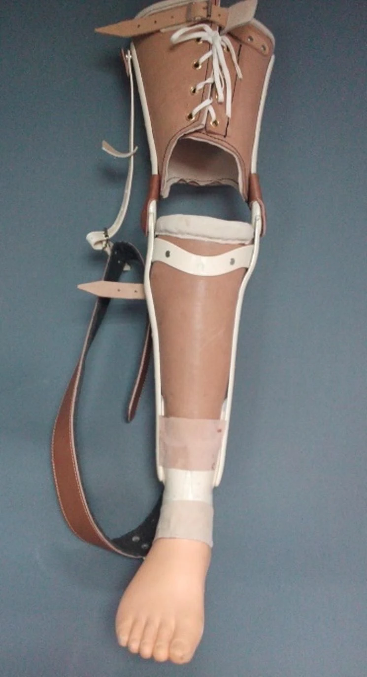 Non-modular lower leg prosthesis PN3-N.1 for short and variable volume stumps