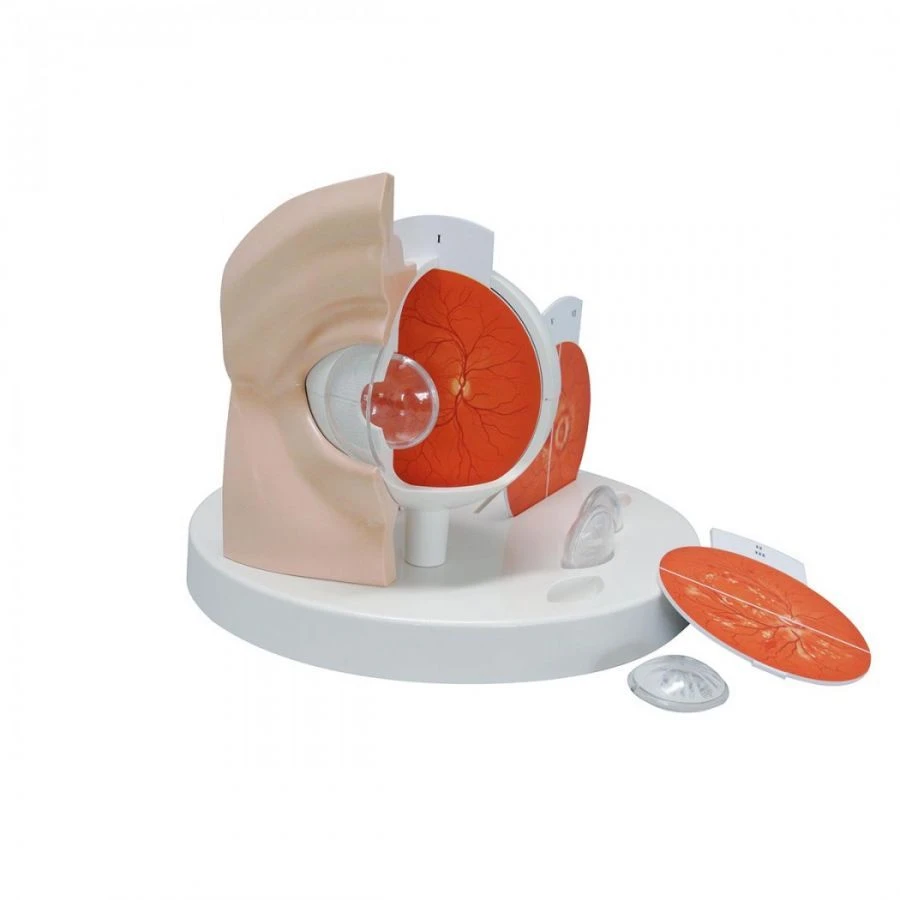 Eye Model with Pathologies, 17110