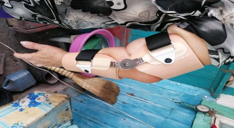 Orthopedic Elbow Joint Device for Upper Limbs