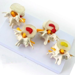 Anatomical Model of Spinal Pathologies, 11208