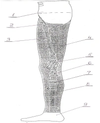 Modular Hip Disarticulation Prosthesis