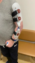 Full Arm Orthotic Device for Distal Limb Stabilization