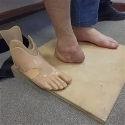 Custom Foot Prosthesis for Partial Foot Amputation