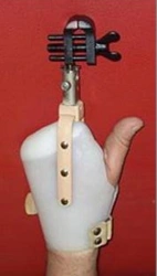 Functional Hand Prosthesis for Partial Hand Amputation PР0-Р.1